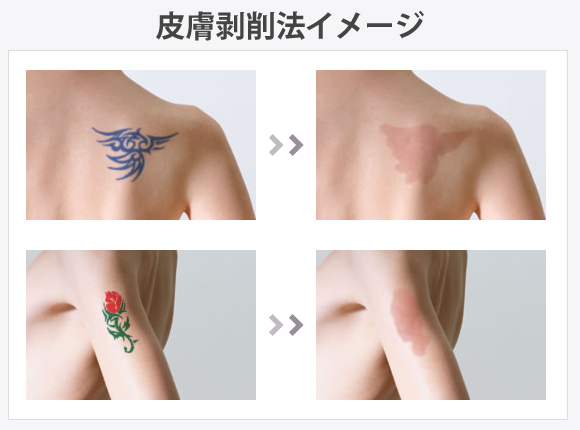 タトゥーのアフターケア方法を解説！かさぶたが剥がれたら