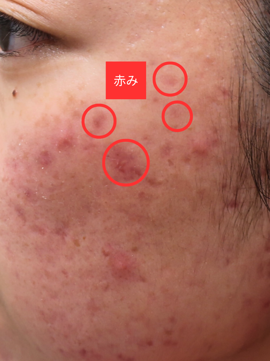 ニキビ跡は治らない？綺麗に改善・消すための効果的な治療法を解説水の森美容クリニック