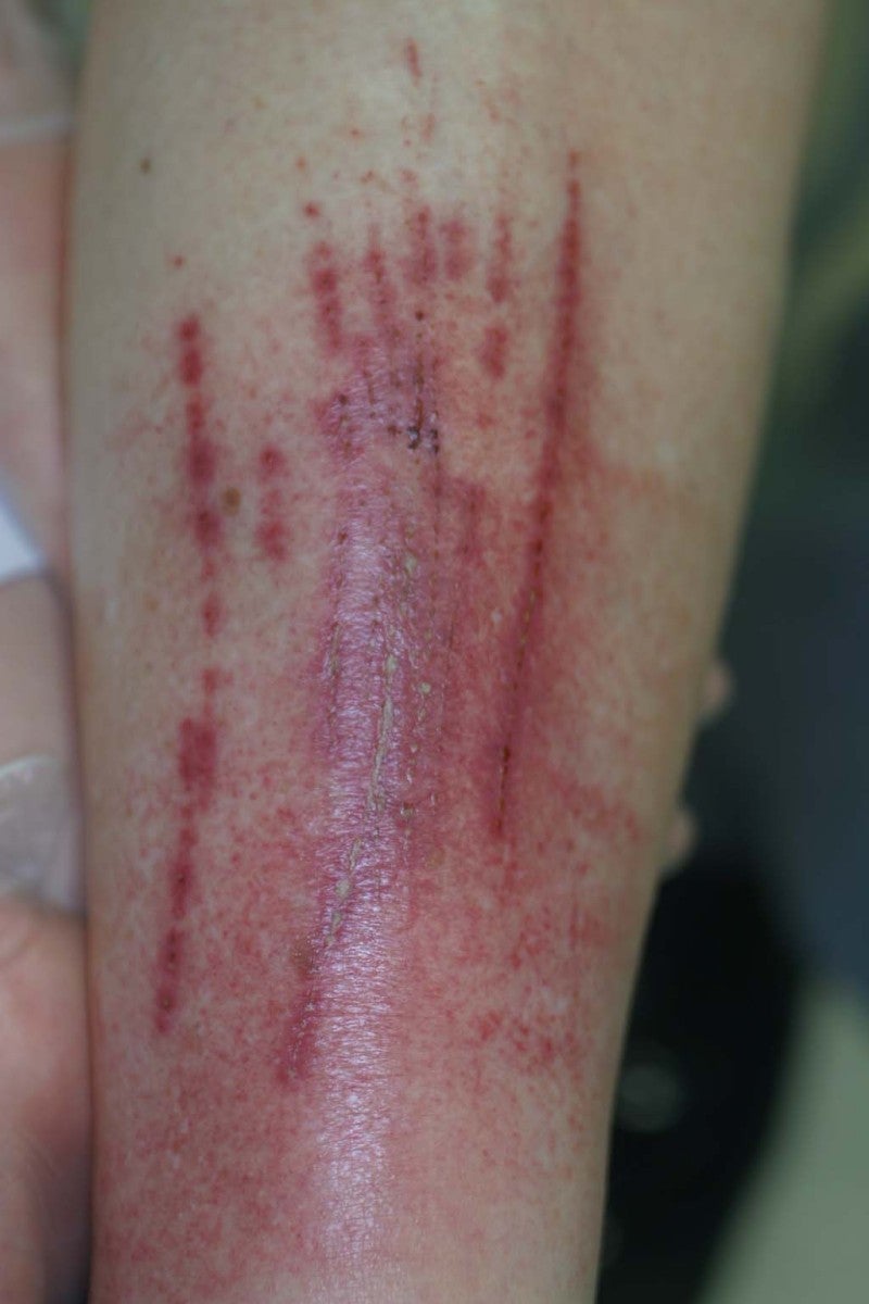 蕁麻疹 じんましん によっておこる症状と対処法、原因について解説西春内科・在宅クリニック 北名古屋市の内科・発熱外来・訪問診療