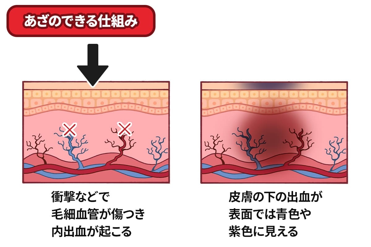 青アザを早く治したいときは？ 意外な原因と対処方法をご紹介ぷらす鍼灸整骨院 大阪・兵庫・東京・横浜・広島で展開中