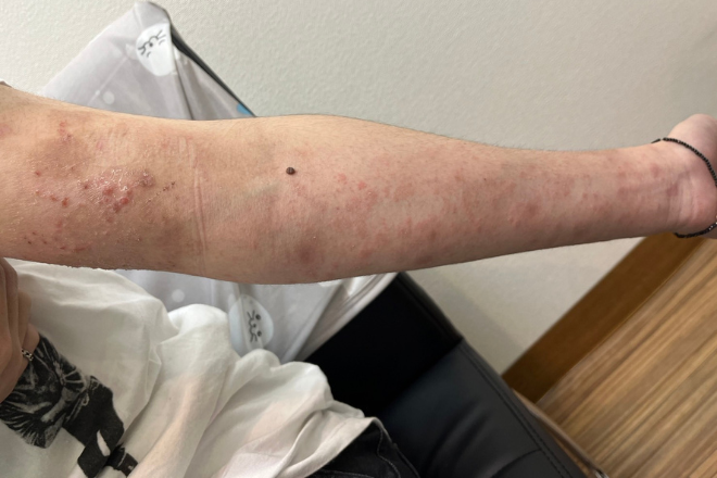 顔赤みやかゆみ 症例３川崎市多摩区のアトピー専門整体「英気治療院」