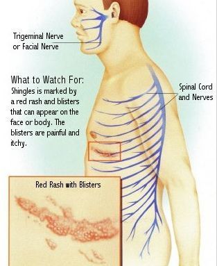帯状疱疹後神経痛の症例 - 葛飾区新小岩・おぐち針灸院で初めてでも安心の鍼灸治療