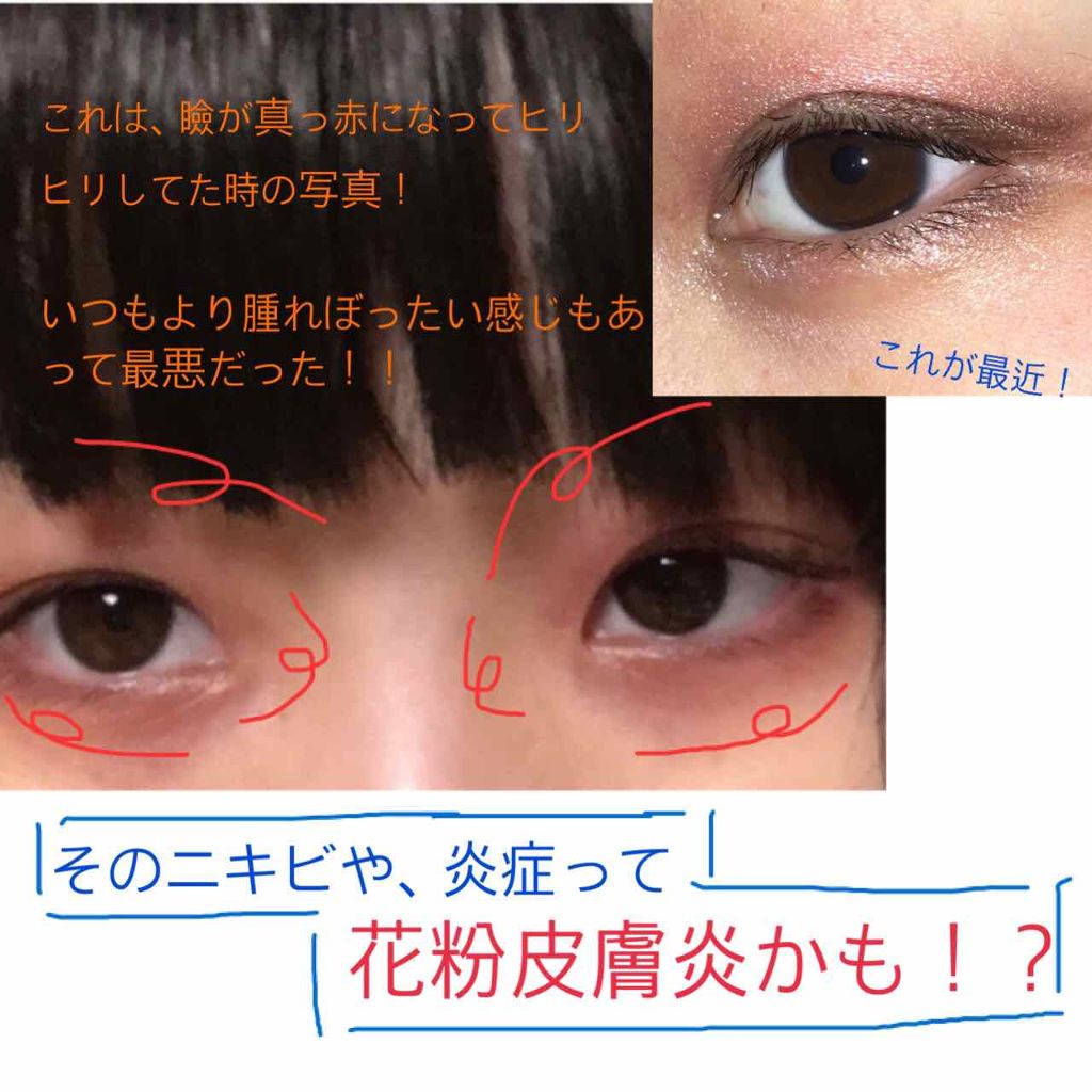 皮膚科医監修 目の周りが乾燥する原因と対策法 ワセリンやニベアなどおすすめクリームもLIPS