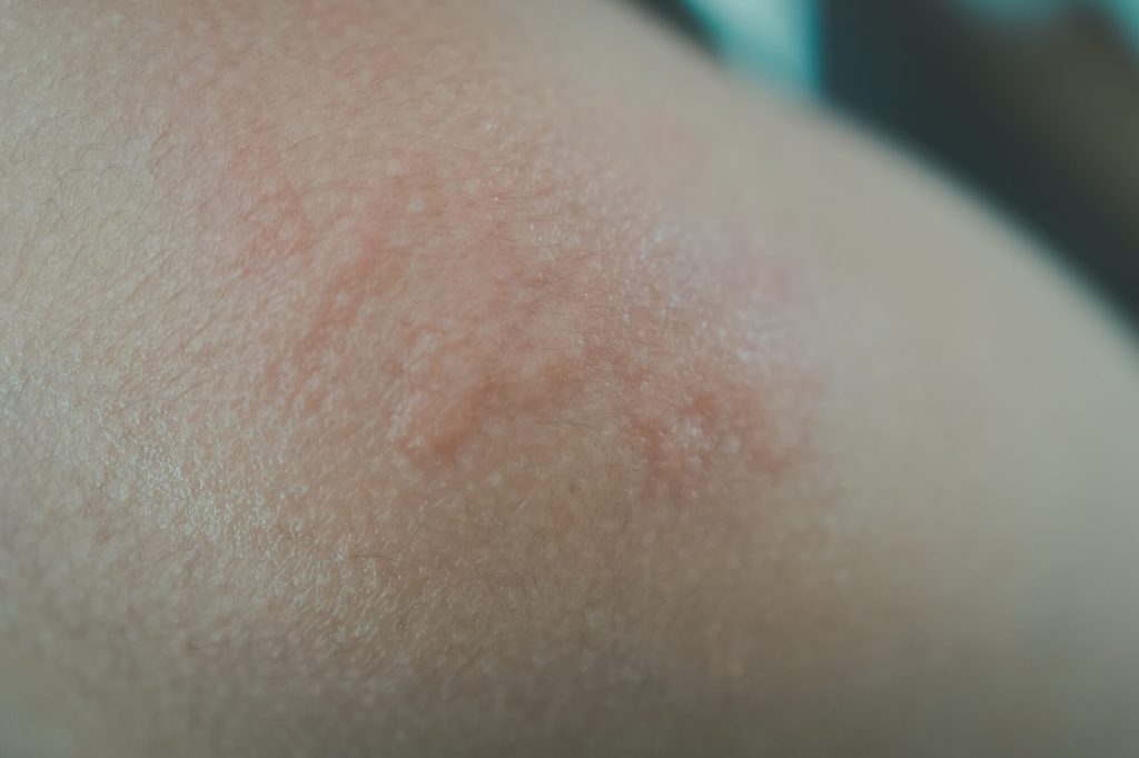 疥癬 かいせん杉沢皮膚科クリニック