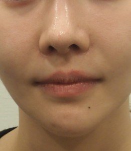 たかが粉瘤、されど粉瘤。 - SSクリニック - 皮膚科・美容外科 - 名古屋市中区