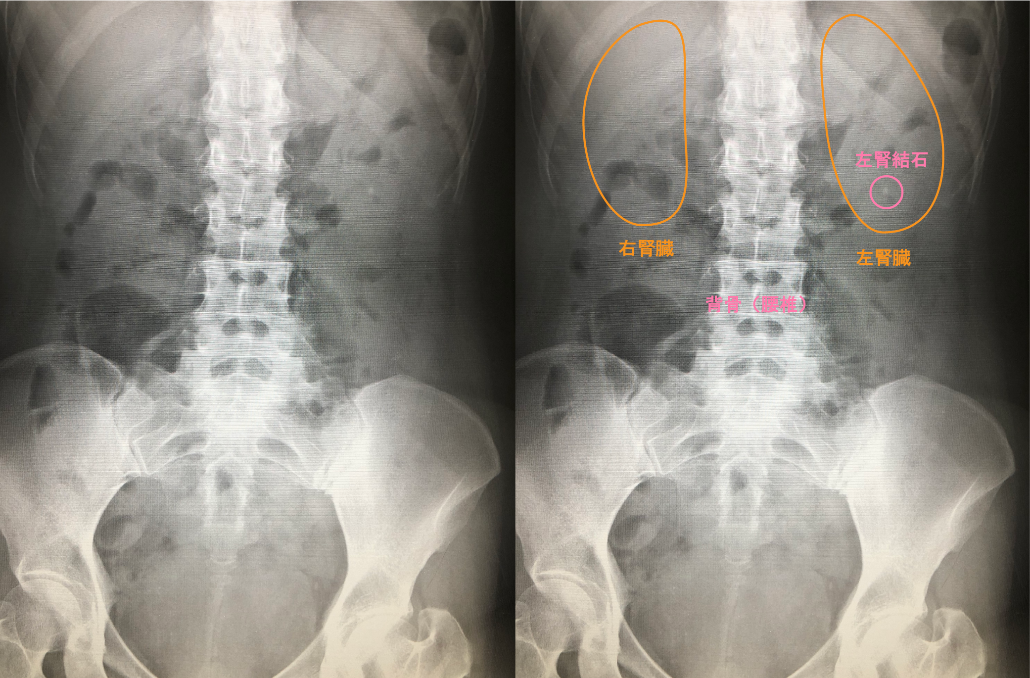 自己流リハビリ避けたいリスク股関節痛の「保存施術」 ginzaplus銀座プラス