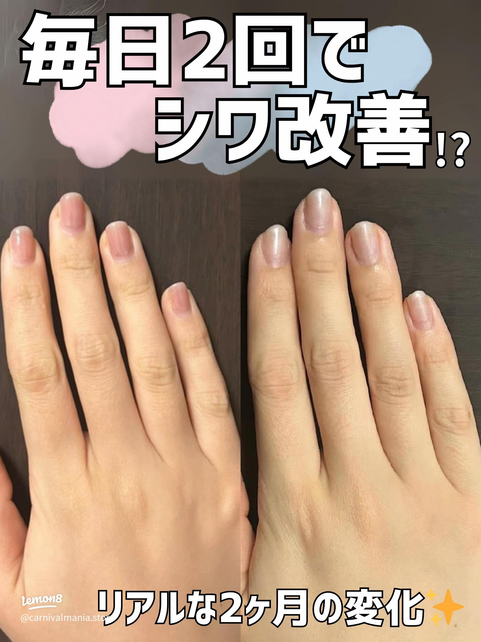 ささくれ、爪の縦線、手のしわ ハンドケアでお悩み改善！ 新百合ヶ丘・五月台ネイルサロン川崎市 新百合ヶ丘 爪噛み癖専門 深爪矯正サロンネイルマジック