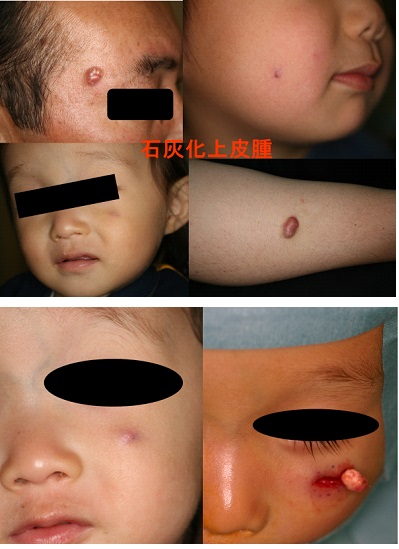 外骨腫、粉瘤、脂肪腫、わきが治療やレーザー脱毛なら 日本橋形成外科 皮フ科・美容外科