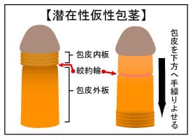 カントン包茎（嵌頓包茎）とは？手術と費用について｜MSクリニック