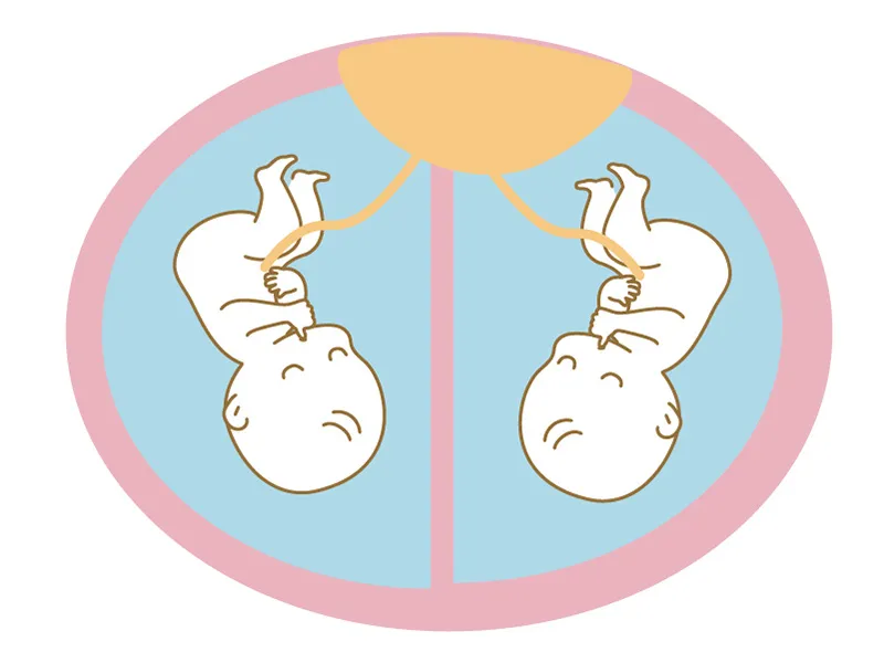 一絨毛膜一羊膜の双子。リスクと対策は？ 匿名希望様岩城産婦人科妊活ブログ