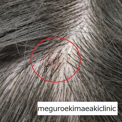 頭のぼこぼこしたできものの原因とは？何科を受診すればいい