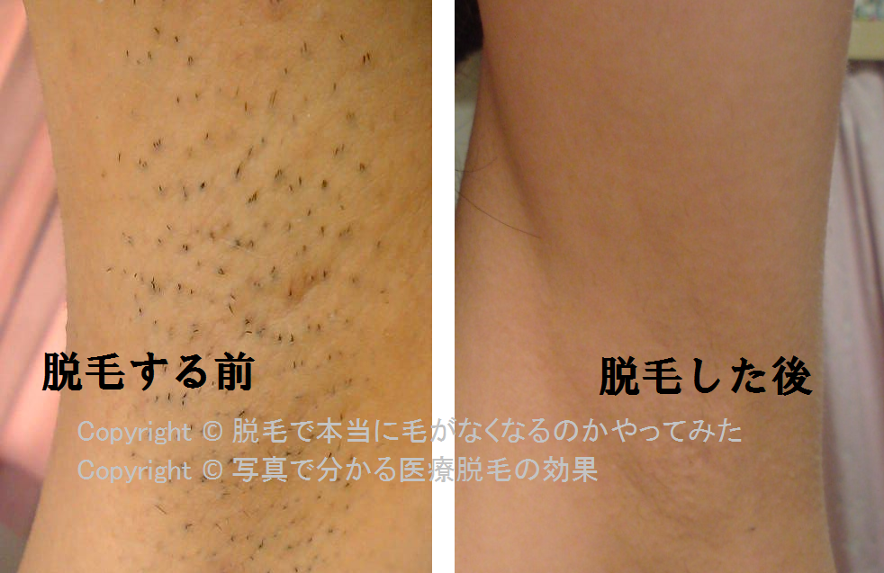 中学生女子の脇毛をケノンで脱毛した結果！子供におすすめの自己処理