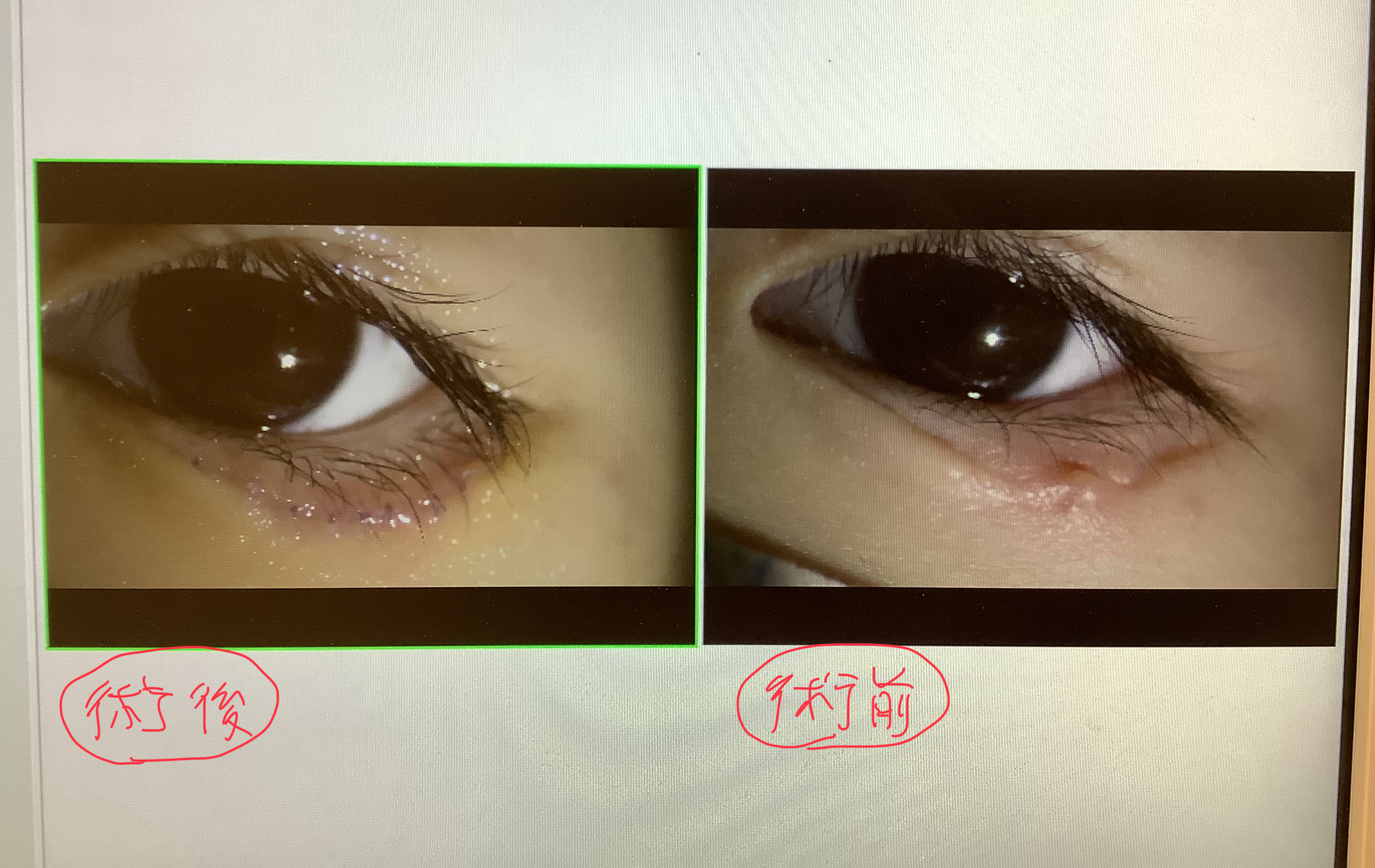 霰粒腫・麦粒腫 ものもらい久が原眼科