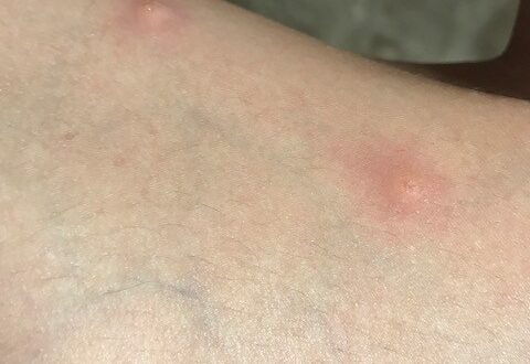 特技はかくれんぼ？トコジラミの見つけ方と刺されないための4つの対策。その他害虫なるほど知恵袋