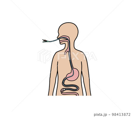 腸閉塞 イレウス の種類のイラスト - 医療のイラスト・写真・動画、素材販売サイトのメディック medick