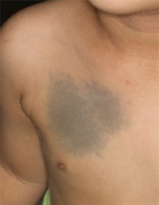 腰部の異所性蒙古斑。生後3か月女の子。 - ドクターリコの明日もＨａｐｐｙ