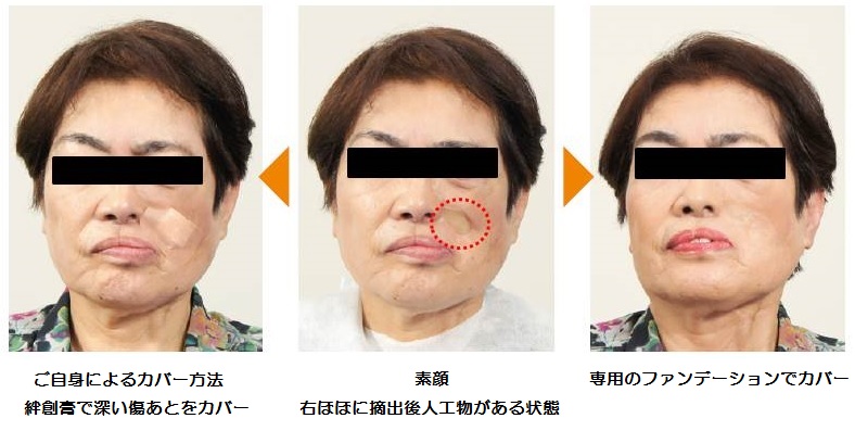 皮膚の悪性腫瘍 皮膚がん品川区 あおよこ皮膚科クリニック