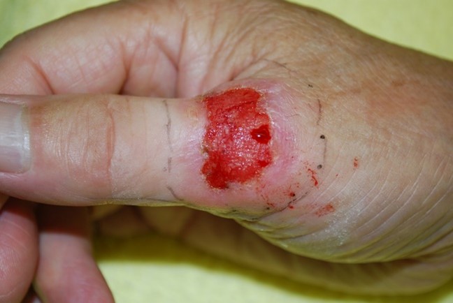 手や足のブツブツ・皮むけ 汗疱、掌蹠膿疱症 町野皮ふ科坂戸市にっさい花みず木の皮膚科