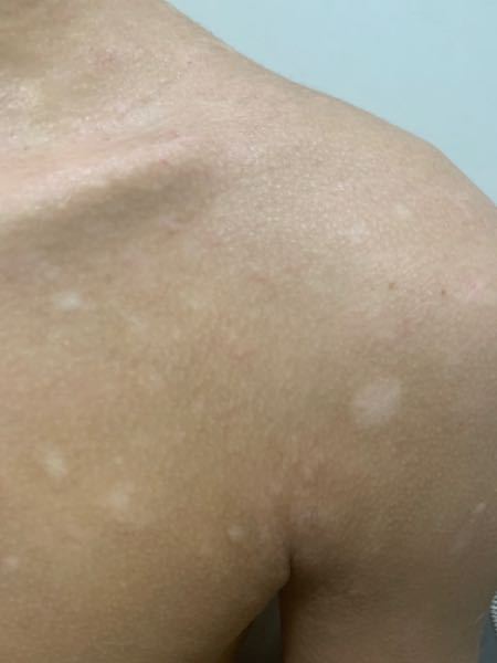 外来で「肌がまだらに白くなった」と訴えられたら 2ページ目 ：日経メディカル