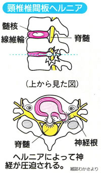 頚椎椎間板ヘルニア・頚椎症の治療 - 脊椎脊髄の病気と治療