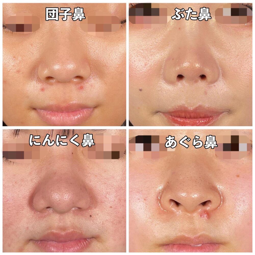 鼻の形の種類・名称とその治療法について だんご鼻・あぐら鼻など池袋の美容皮膚科・美容外科ならみずほクリニック
