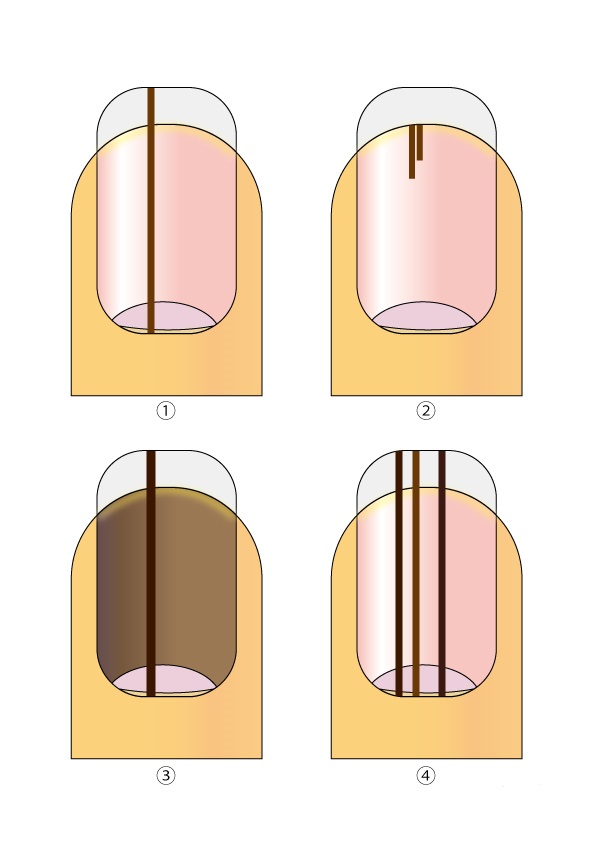 Shinji Ogawa🚩二つの共通点→この二つの写真の病気の共通点はずばり「異物肉芽腫」です。 ①陥入爪 短く切りすぎた爪の角 異物 が皮膚に刺さっている②粉瘤 皮下にある袋が破裂してその内容物 異物 が漏れ出たことに対する反応 「感染性粉瘤」という病名は正しくなく