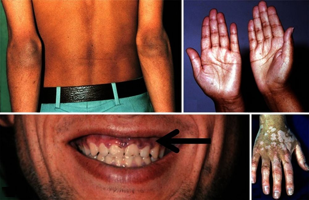 メラニン色素沈着口腔病理基本画像アトラス