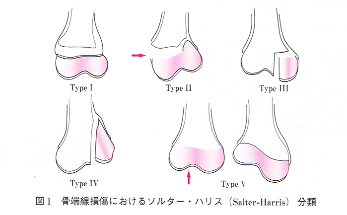 シーバー病 – まつい整形外科 桜坂スポーツ関節クリニック