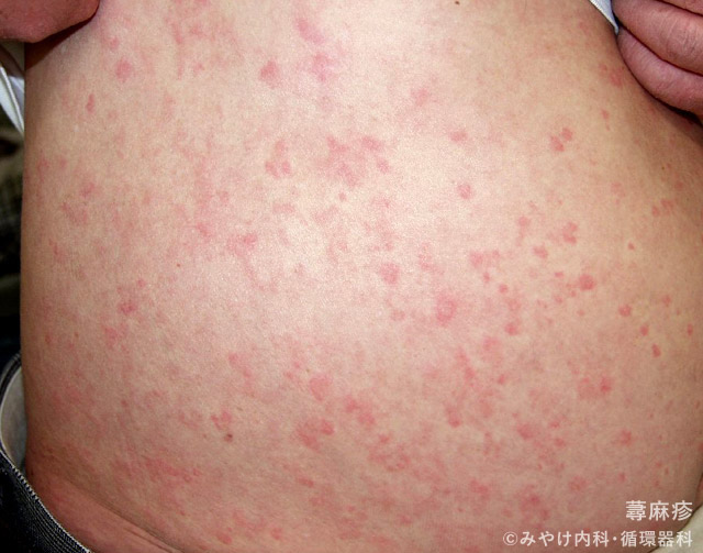 蕁麻疹 じんましん下永谷内科・皮フ科