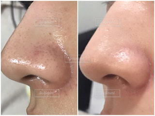 目の下の白いぶつぶつ 稗粒腫 取れますか？白崎医院blog 高岡市の皮ふ科 子どもの皮ふ 美容皮膚科