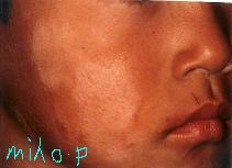 👧👦 夏に相談が多い 単純性粃糠疹 ひこうしん ・俗名はたけ 幼児や小学生の、主に顔に 出現する境界があまりはっきりとしない脱色素斑 白抜け のことです。 夏に日焼けをすると はたけの面は黒くなりにくいので 白さが目立ってきます。 通常、かゆみのない場合が