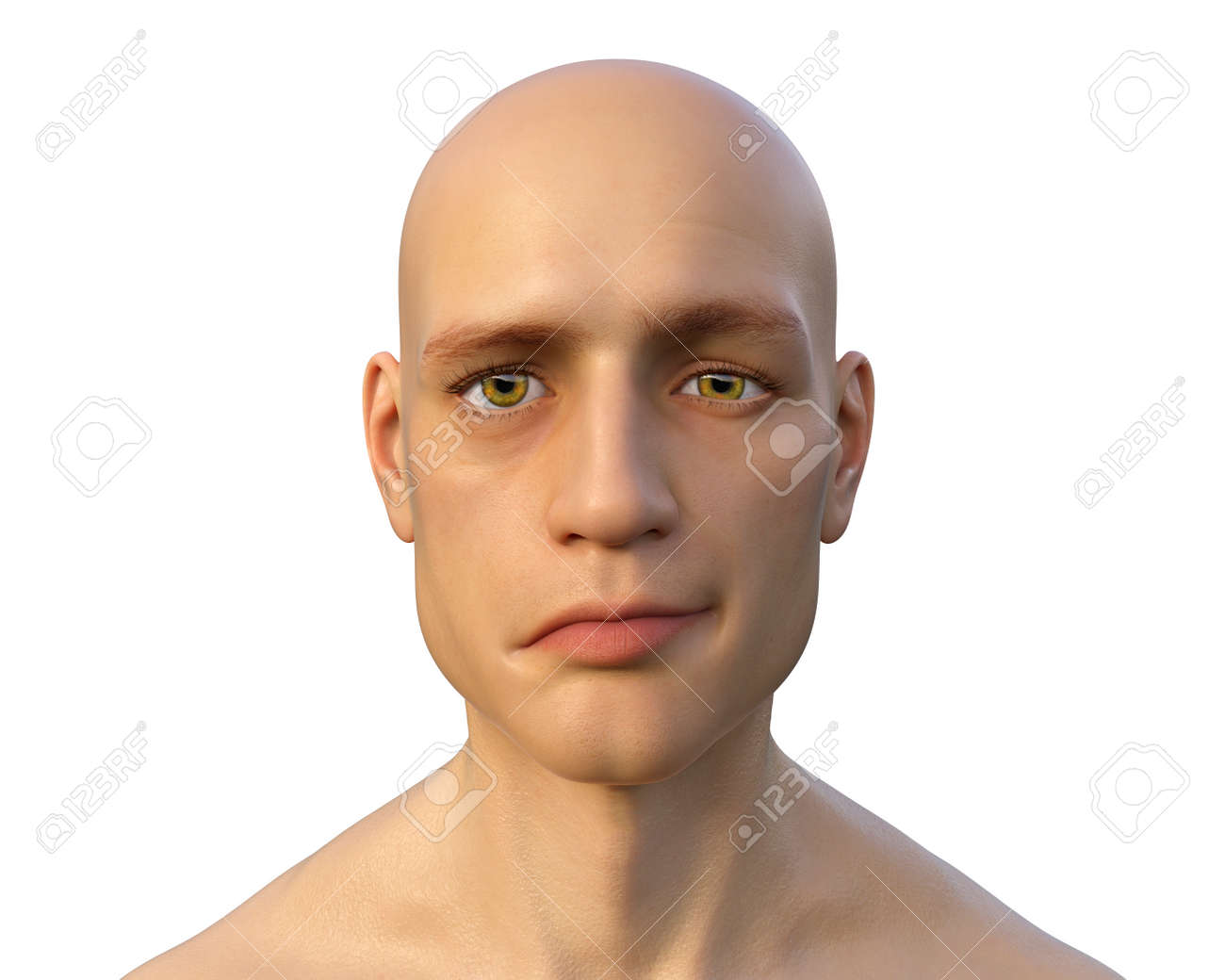 顔面神経麻痺の治療ベル麻痺・ハント症候群, 聴神経腫瘍などの脳腫瘍, 生まれつき・外傷による顔面神経麻痺に対する形成美容外科治療専門サイト