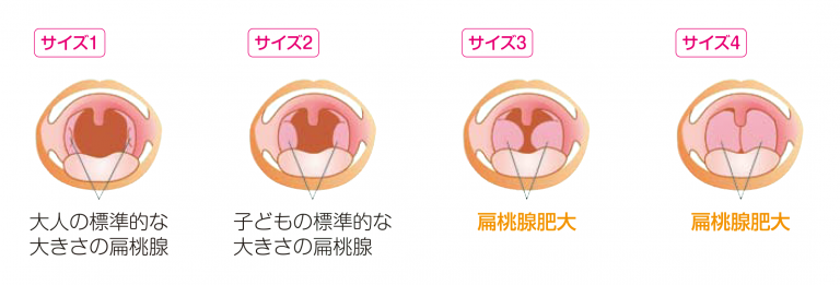 子供のいびき子供の病気コラム楓みみはなのどクリニック一宮市の耳鼻咽喉科
