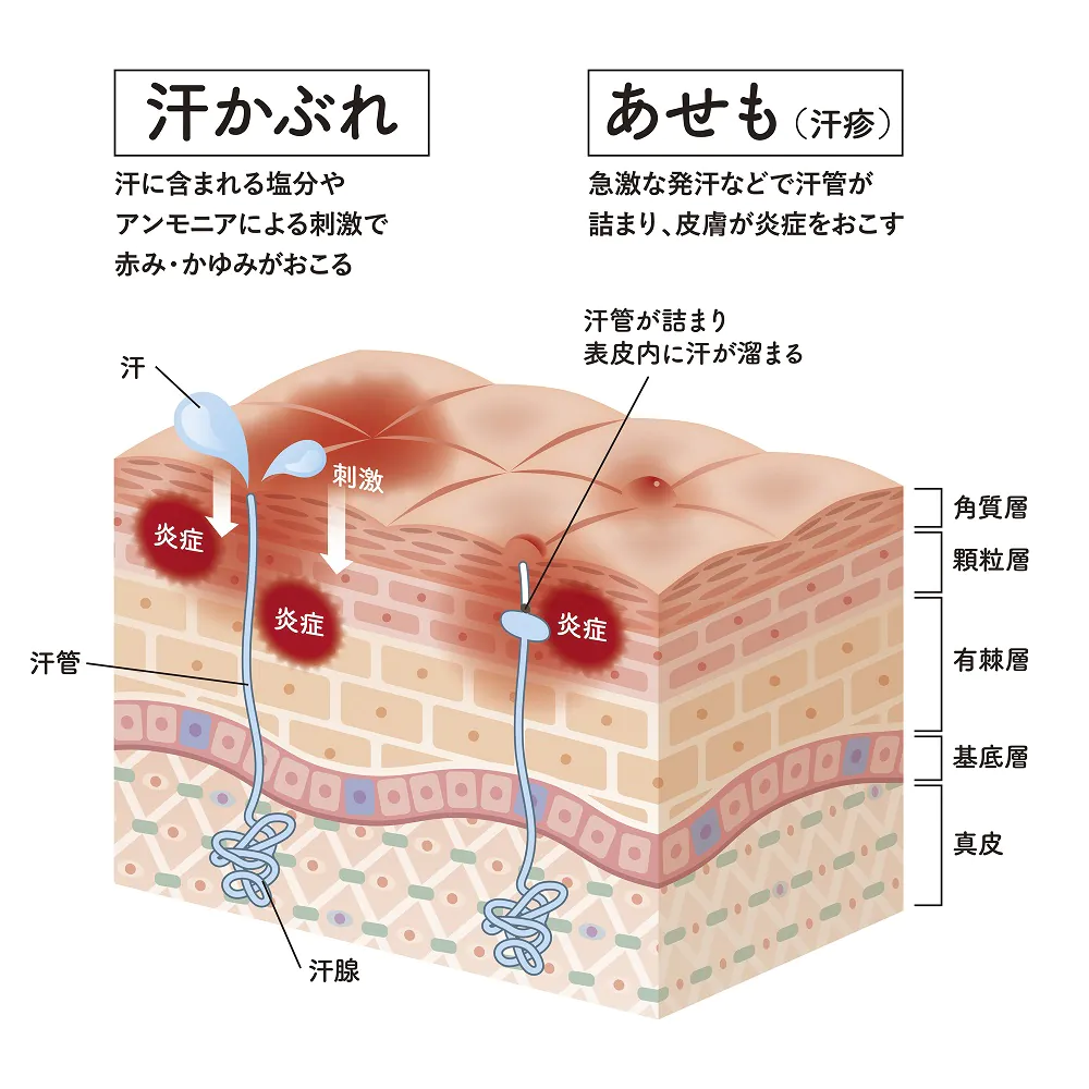 あせも - 北九州市小倉の脱毛、シミ治療はケーズ皮膚科 美容皮膚科