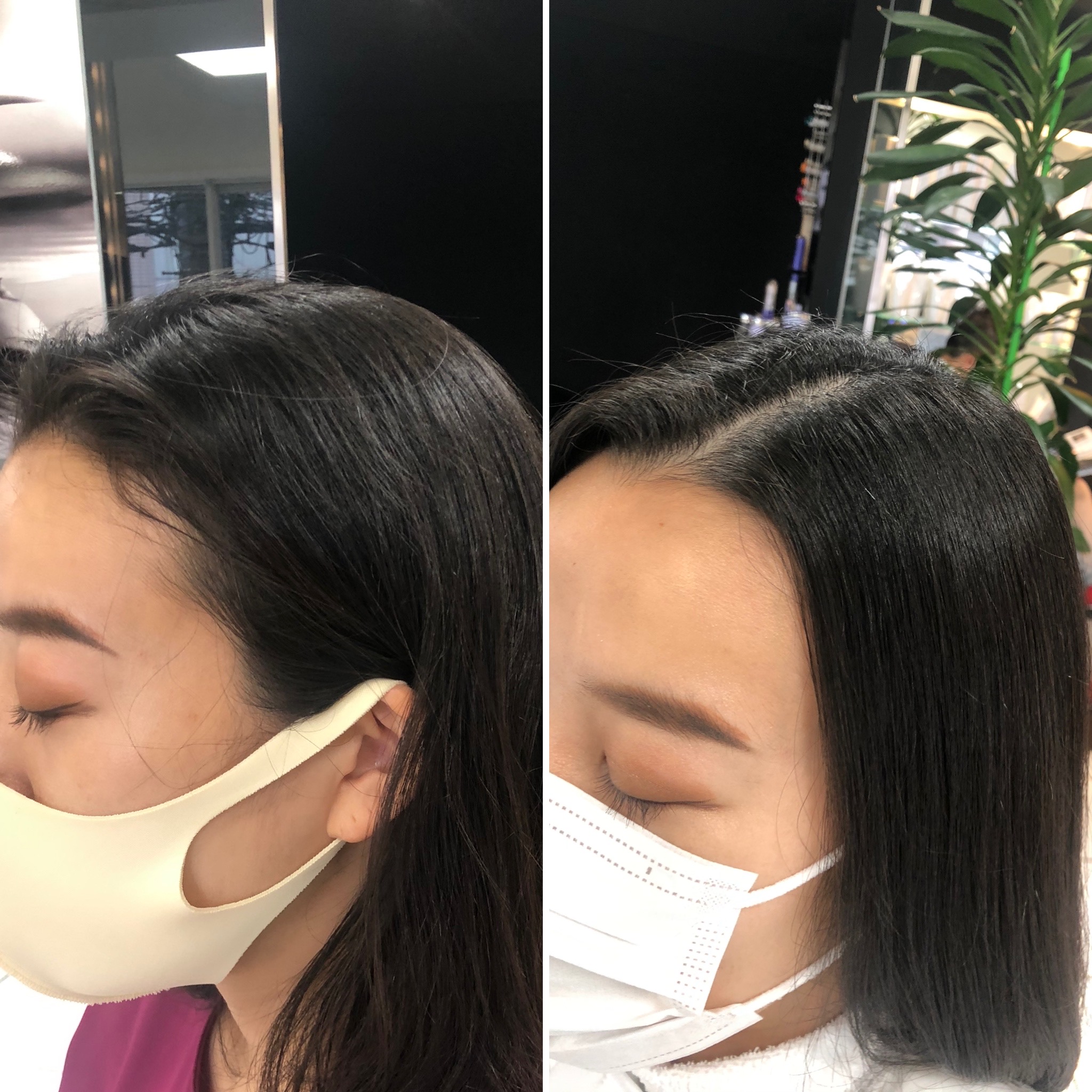 女性のおでこの後退を防ぐために：原因と効果的な対策法ベアAGAクリニック新宿で薄毛治療なら当クリニック