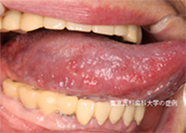 地図状舌口腔外科症例解説東京銀座シンタニ歯科口腔外科クリニック