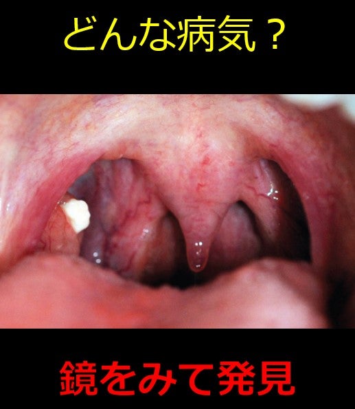 扁桃膿栓 喉にある白いのは何ですか？原因不明と戦う総合診療医ドクターP