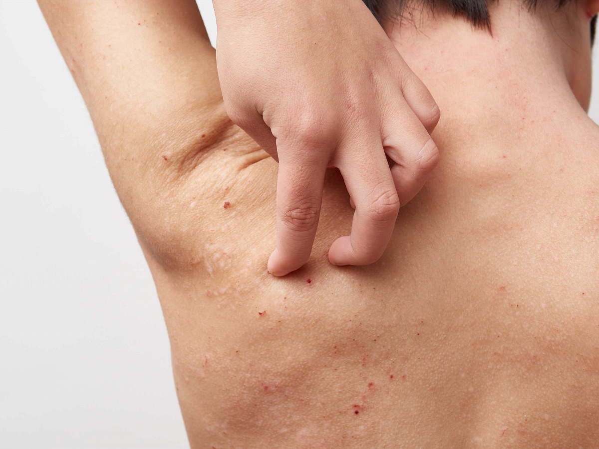 皮脂欠乏症」 乾燥による肌のかゆみが睡眠障害やうつ病の要因になることも 治療法は？ヨミドクター 読売新聞