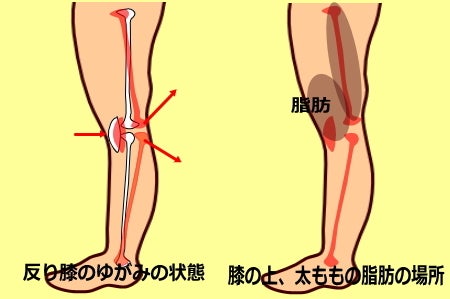 O脚・X脚、加齢や歩き方も原因 膝の筋肉鍛え痛み予防 - 日本経済新聞