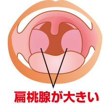 扁桃炎・扁桃肥大・扁桃周囲炎西宮市今津駅前のひだ耳鼻咽喉科