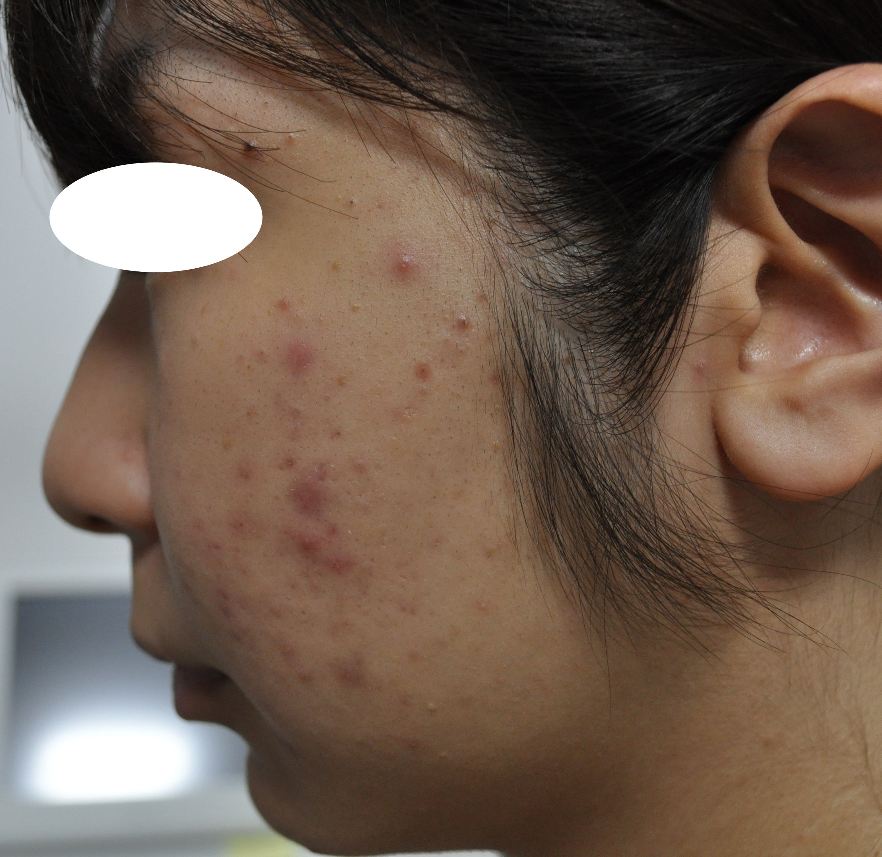 ニキビ痕でお困りの方も諦めないでください。最新の技術を使い治療を行います。粉瘤・ほくろ除去で皮膚科をお探しなら はなふさ皮膚科へ