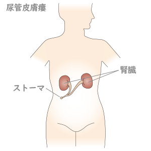 腎盂尿管がんじんうにょうかんがん とは済生会