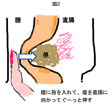 おしりの穴が痛い場合の対処法を症状別に紹介井の頭通りこう門科胃腸科