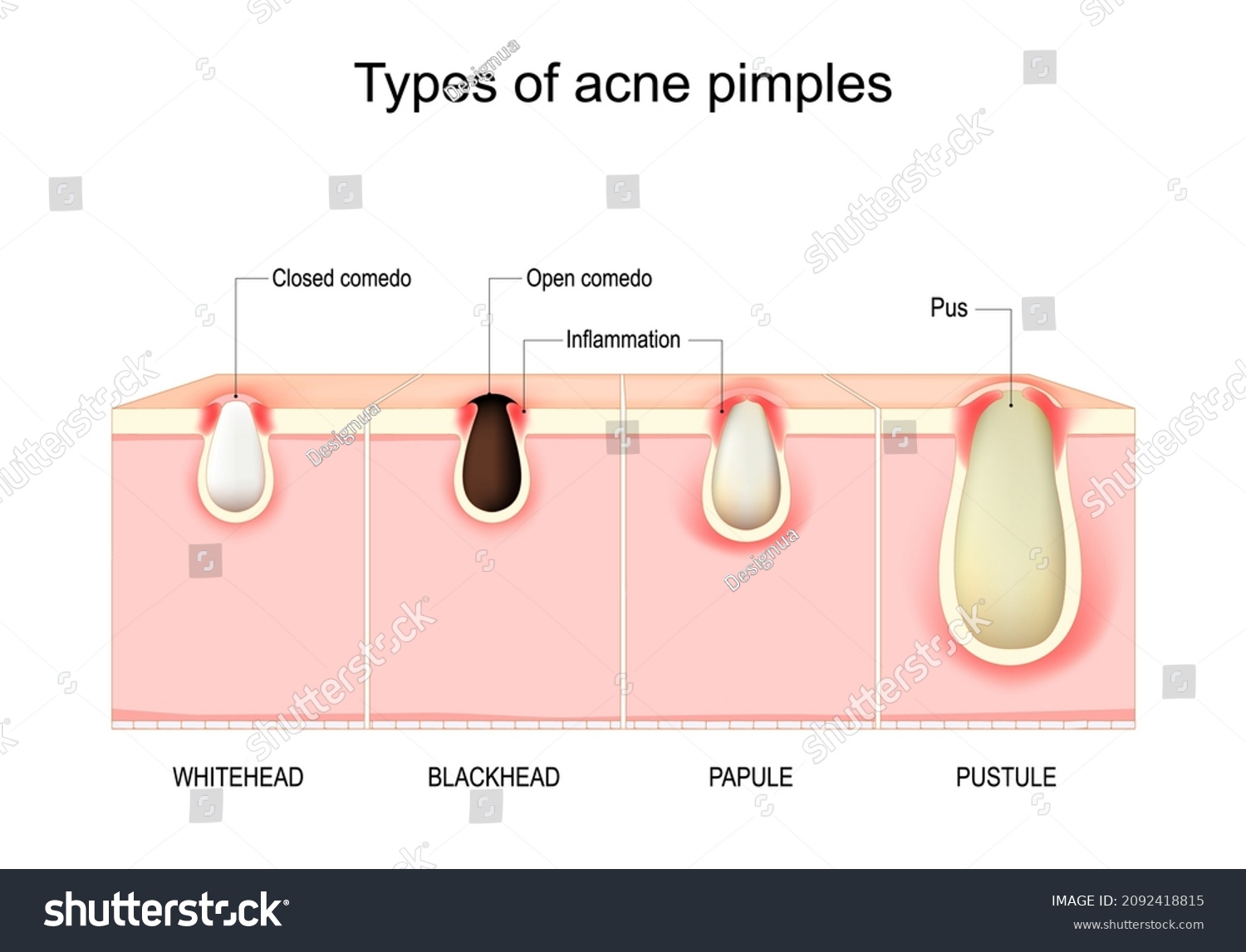 ニキビの場所別・症状別・タイプ別の原因と予防、あなたはどれに当てはまる？美容皮膚科タカミクリニック 東京 表参道