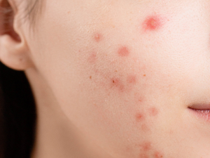 毛嚢炎って何？ 毛嚢炎の原因と予防対策についてTCB脱毛公式