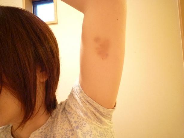 身に覚えのないあざが黄色い？考えられる原因と対処法を解説「さかぐち整骨院 -枚方市-」枚方市で口コミ評価NO.1