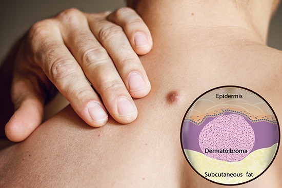 神経系腫瘍の手術を行うなら渋谷駅前おおしま皮膚科