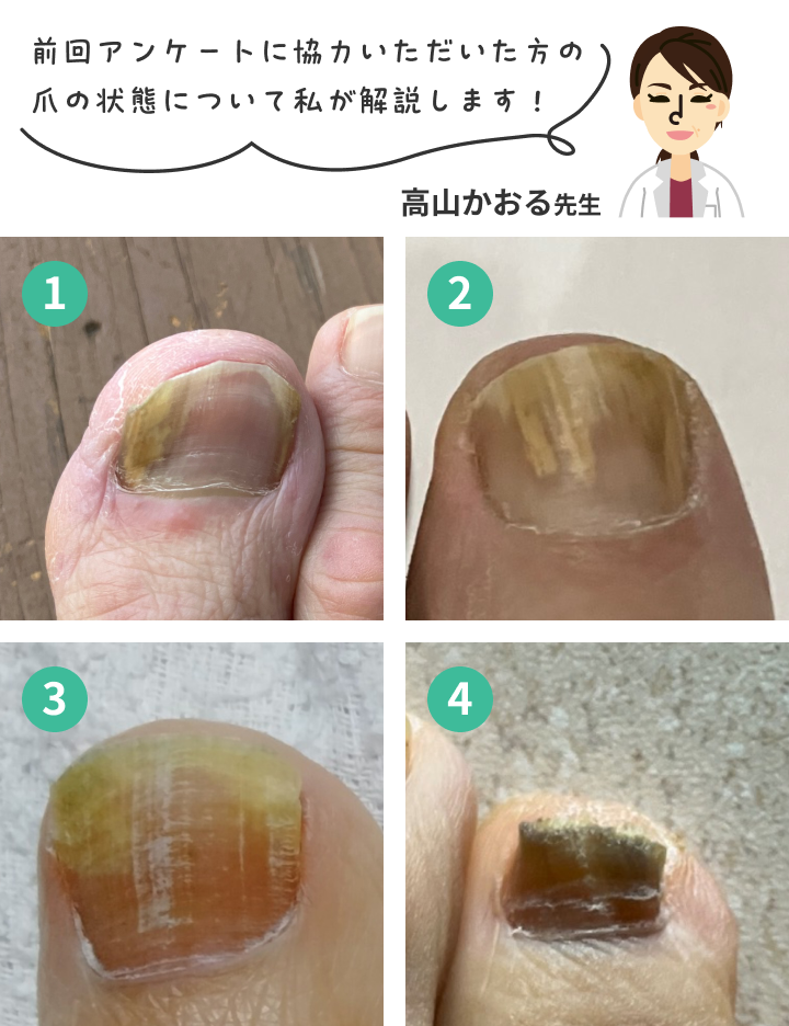 爪の病気：知らないと怖い爪の健康 -ネイルサロンでよくある爪の症状 - Bijou Nails ビジューネイルズ