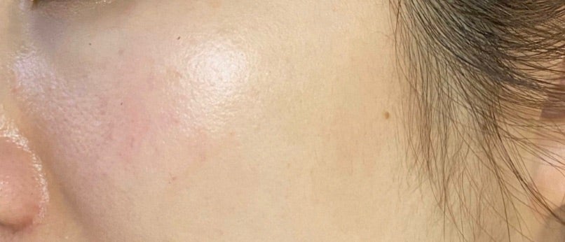 白斑 培養表皮矢永クリニック -Yanaga CLinic