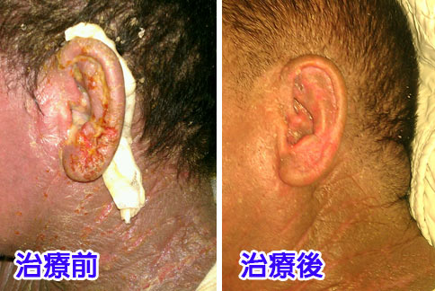 医者：「今まで見た中で一番ひどい耳の乾癬だ」 : r Psoriasis